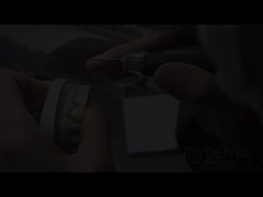 Grashüpfer-Feneriere Die perfekte Lösung für natürliche durchsichtige Zahnfeneriere