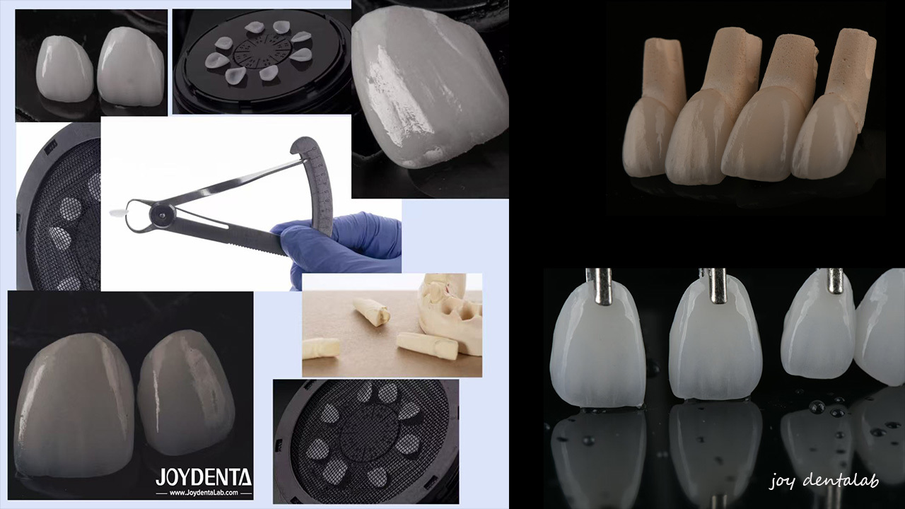 Jüngste Firmenblogs über Emax Zahnfineren -- Globaler Premiumhersteller