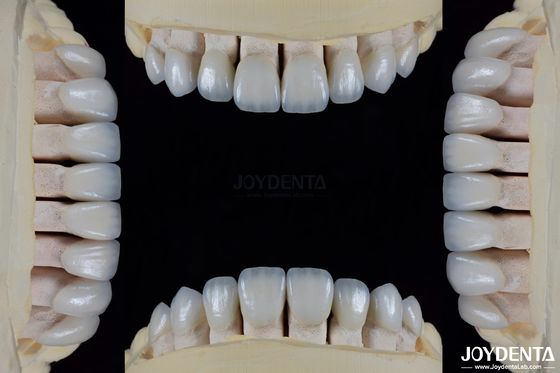 Keramik für natürliche Ästhetik Zahnfolie Fleckenbeständigkeit Beibehält Helligkeit Starke Bindung mit Zahnschmelz für eine sichere Passform