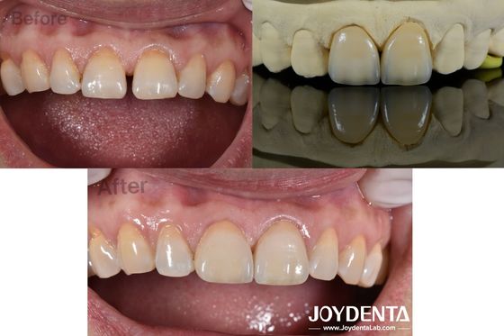0.5mm Dicke Zahnfineren Perfekte Durchlässigkeit Porzellanfineren für Spaltzähne