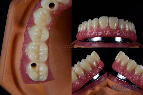 kaufen Titanium-Mehrzahnimplantate Zähne Innere Implantate Rissbeständig individuell on-line-Fertigung