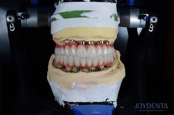 kaufen 10 mm Länge Einzeltand Implantat Gamma bestrahlt für optimale chirurgische Ergebnisse on-line-Fertigung