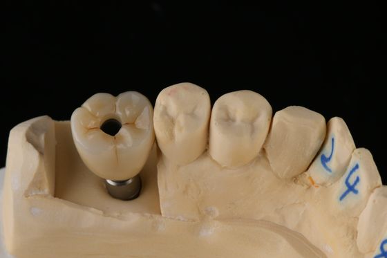 kaufen 3.75mm Silber Titanschraube Zahnimplantat Einzeltandersatz Implantat on-line-Fertigung