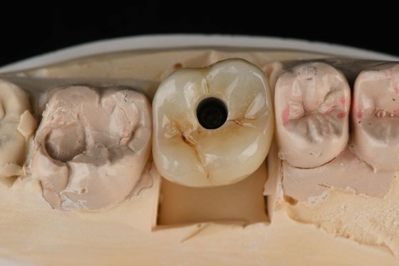 kaufen Titanium 10mm Einzahnzahn Zahnimplantate Ersatz Abutment Selbstklemmen Sandblasen on-line-Fertigung