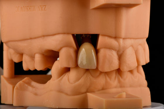 kaufen Innere Hex 3,0 mm Tiefe 1,5 mm Schrägstärke Einzeltitan-Zahnimplantat on-line-Fertigung