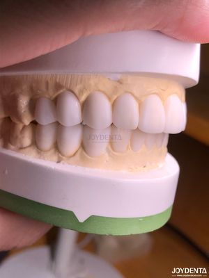 kaufen Personalisierte Digitale Diagnostik-Wax-Ups für natürliche Zahnanatomie-Replikation on-line-Fertigung