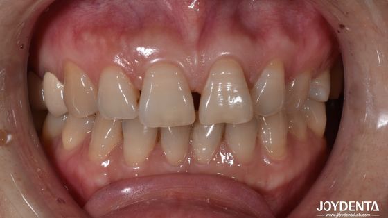 kaufen 0.5 mm Dicke Keramik Zahnfineren Natürliche Suche nach vorderen Zahn Anzeige on-line-Fertigung
