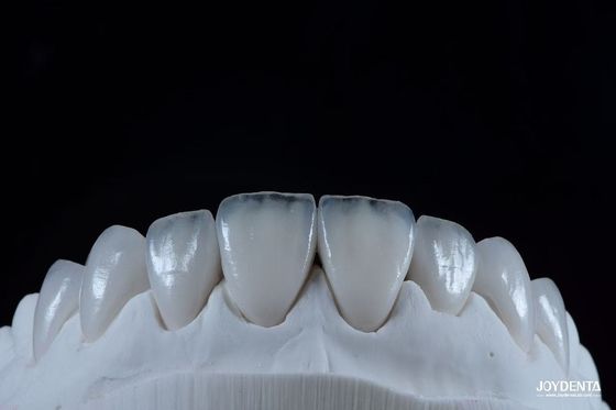 kaufen Natürlich aussehende Emax Porzellan Veneer Komfortabel passend Ultra dünne Emax Veneers on-line-Fertigung