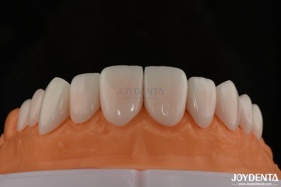 kaufen A1-A4 Ips Emax Press Porzellan Zahnfineren Fleckenbeständig Anpassungsform on-line-Fertigung