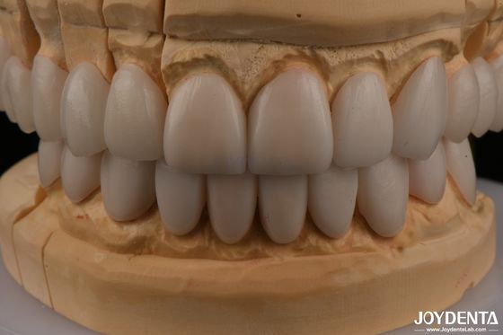 kaufen 0.3 mm Dicke Ips Emax Veneers Keramik Veneers Vorder- und Hinterseiten Restaurierungen on-line-Fertigung