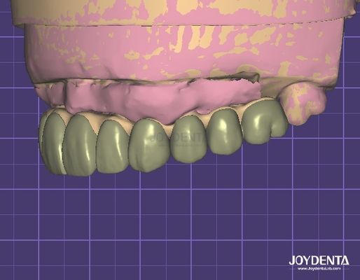 kaufen HIPAA-konforme Datensicherheit Digital Wax Up 3D-Modell für Zahnmodifikationen on-line-Fertigung