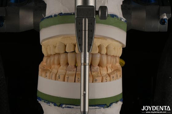 kaufen Hochesthetische Porzellanschicht Zahnzirkonie für Implantat-Restaurierungen on-line-Fertigung