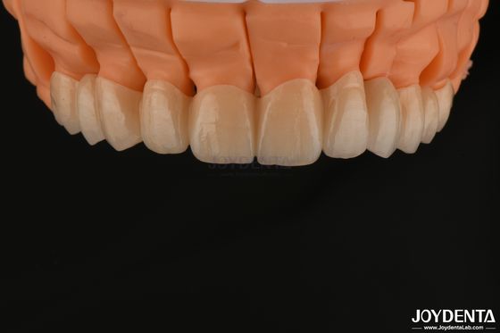 kaufen Hochesthetische Schichten Zirkonia Einzelkronen Brücken Implantat für Zahnrestaurationen on-line-Fertigung