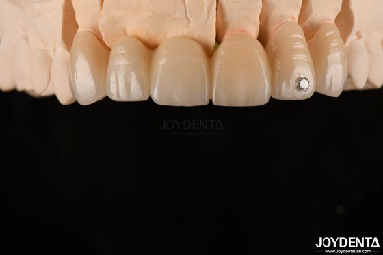 kaufen CAD / CAM Fräsen Dental Schicht Zirkonia für Einzelkronen 0,3-0,5 mm Schichtdicke on-line-Fertigung