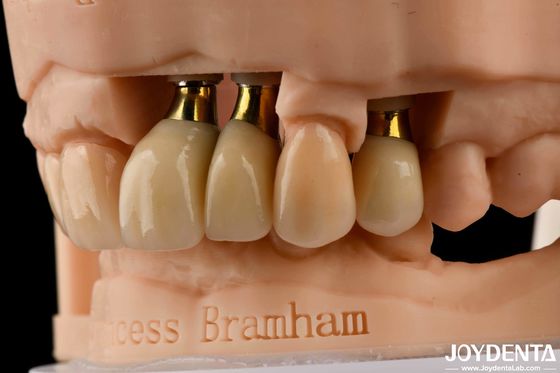 kaufen Präzisions Implantate Krone und Brücke Perfekte Lösung für ein ästhetisch ansprechendes Lächeln on-line-Fertigung