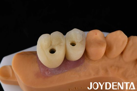 kaufen Porzellan Implantate Krone und Brücke Die ultimative Lösung für die Wiederherstellung fehlender Zähne on-line-Fertigung