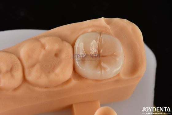 kaufen 0.5mm-2mm Präzisionsfit Emax Zahn Inlay Onlay für zuverlässige Zahnwiederherstellung on-line-Fertigung