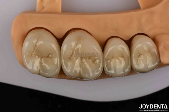 kaufen Premium-Kronen aus Gold- und Palladiumlegierungen für eine höhere Haltbarkeit on-line-Fertigung