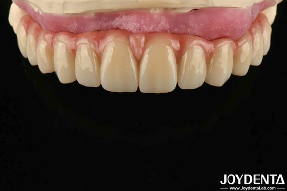 kaufen Komfortable Tragen Titan Malong Hybridbrücke Zahnverstellbares Design Leichtgewicht on-line-Fertigung