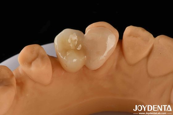 kaufen Emax Maryland Veneer klinische Bindung Adhäsion für Farbgleichung Zahnreparatur on-line-Fertigung