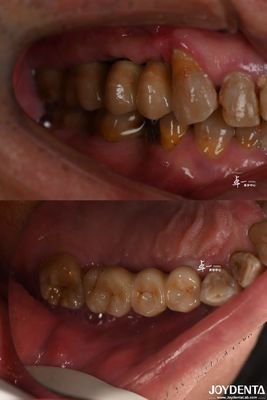 kaufen Zahnimplantat für Subcrestal Knochenniveau Titanmaterial on-line-Fertigung