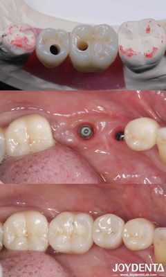 kaufen Zylindrische All-on-4-Titan-Zahnimplantate 10-16 mm Länge Hex-Verbindung on-line-Fertigung
