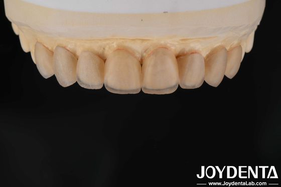 kaufen Natürliches Aussehen Glas Keramik Veneers, Zahnklinik Veneers Starke Bindung on-line-Fertigung
