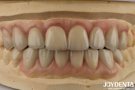 kaufen Hohe Durchsichtigkeit Emax Kosmetik Zahnpflege Veneers Hohe Ästhetik Ultra dünn on-line-Fertigung