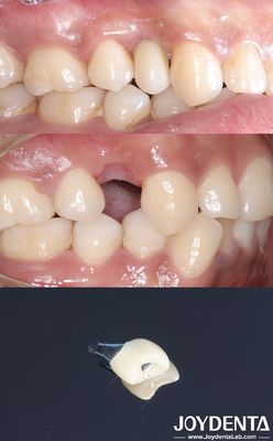 kaufen All On 4 Zahnimplantat Zylindrische Form Titan Implantat Zahnimplantat Raue Fläche on-line-Fertigung