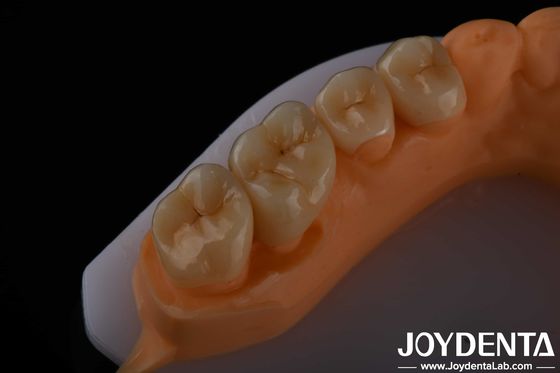 kaufen Hohe Ästhetik Vollkontur Zirkonia für Kronen Brücken Implantate Zahnpflege on-line-Fertigung