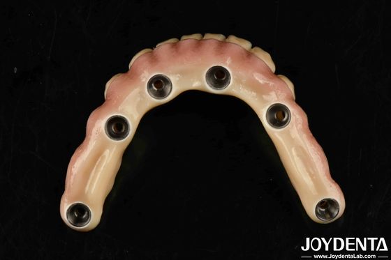 kaufen Dauerhafte Zahnärztliche ästhetische Titan-Malong-Hybridbrücke für die Pflege on-line-Fertigung
