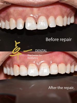 kaufen Grüßen Sie ein makelloses Lächeln mit kosmetischen Zahnfineren ohne Verfärbung ohne Vorbereitung on-line-Fertigung