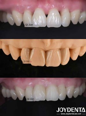 kaufen Grashüpfer-Feneriere Die perfekte Lösung für natürliche durchsichtige Zahnfeneriere on-line-Fertigung