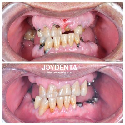 kaufen Widerstandsfähig gegen Verschleiß und Verformung Zirkonia Zahnkronen Langlebig und geeignet für Rücken- und Vorder-Restaurationen on-line-Fertigung