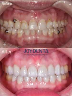 kaufen Zahnfineren für fehlende Zähne. Global Premium Dental Lab Services on-line-Fertigung