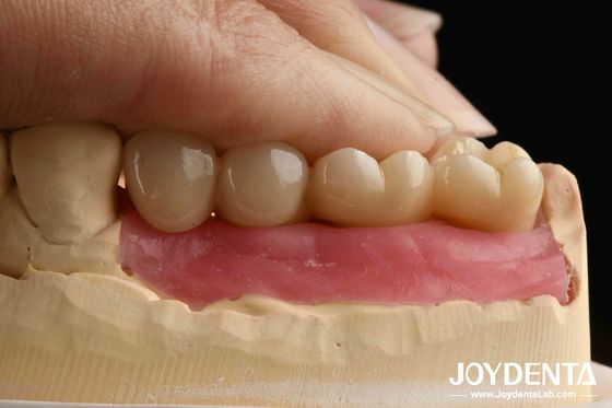 kaufen Ultra-präzise Verarbeitung Zirkonia-Implantate mit KI-gestütztem Design und Bionisches Gingival Piercing für eine vollständig Zirkonium-Integrierte Krone on-line-Fertigung