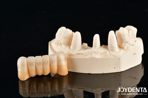 kaufen Unveil True Biomimicry: Introducing Our Multi-Layered Zirconia Aesthetic Bridge on-line-Fertigung