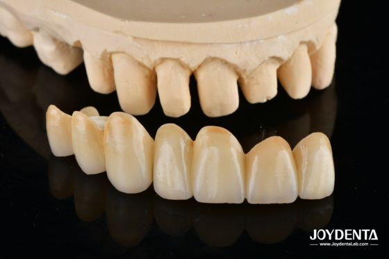 kaufen Unveil True Biomimicry: Introducing Our Multi-Layered Zirconia Aesthetic Bridge on-line-Fertigung