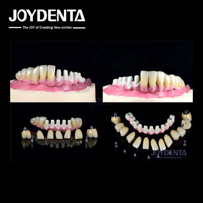 kaufen Mehrfache endosöse Zahnimplantate Internalverbindung zur vollständigen Bogenwiederherstellung on-line-Fertigung