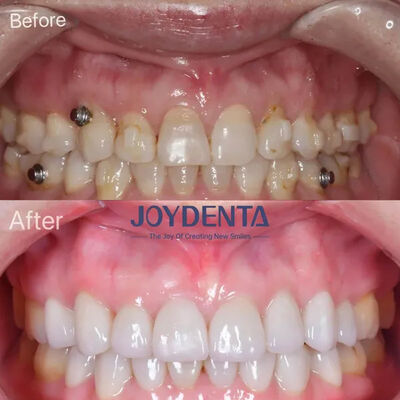 kaufen Zahnfineren für fehlende Zähne. Global Premium Dental Lab Services on-line-Fertigung