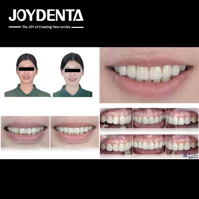 kaufen Die beliebtesten Produkte von Joydentalab: Simulierte ästhetische Veneers on-line-Fertigung