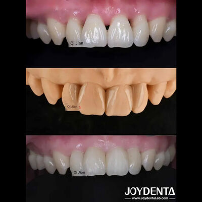 kaufen Grashüpfer-Feneriere Die perfekte Lösung für natürliche durchsichtige Zahnfeneriere on-line-Fertigung