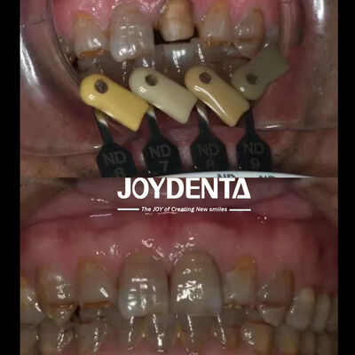 kaufen Transluzente Zirkonie-Kronen Mehrschicht-Gradentiertechnologie on-line-Fertigung