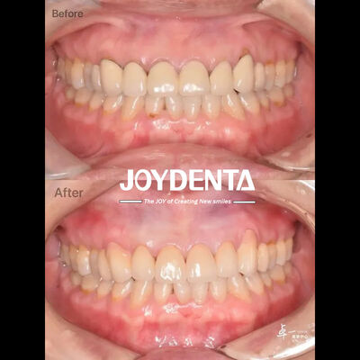 kaufen Dental Zirkonoxid für sicheres Mundgewebe und CAD/CAM-Kompatibilität on-line-Fertigung