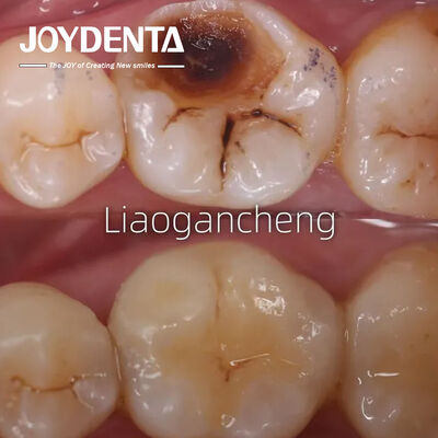 kaufen Porzellane Zahnpflege für Erwachsene und Kinder außergewöhnliche Leistung on-line-Fertigung