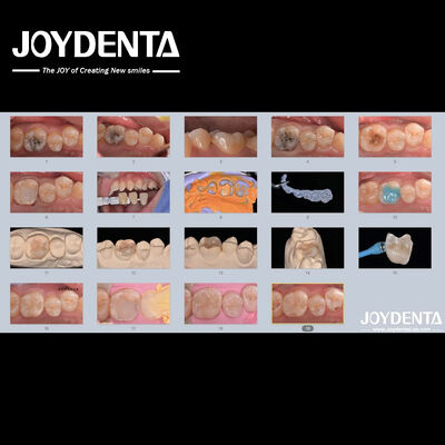 kaufen Erwachsene Kinder Porzellan-Keramik-Zahn-Inlay Wiederherstellung für beschädigte Zähne on-line-Fertigung