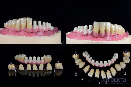 Mehrfache endosöse Zahnimplantate Internalverbindung zur vollständigen Bogenwiederherstellung