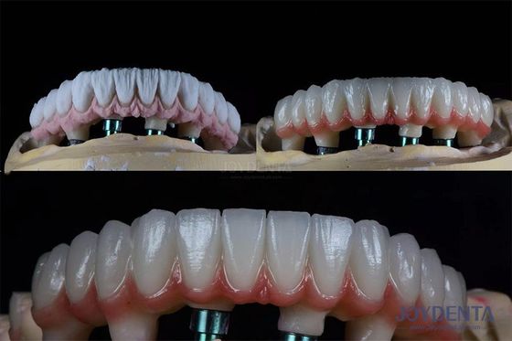 10 mm Mehrzahn-Zahn-Zwei-Stufen-Zahnimplantat-Kit für endosöse Prothesenkrone
