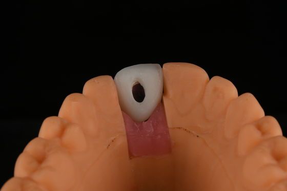 Titanium-Zahnimplantate mit abgegrabener Oberfläche