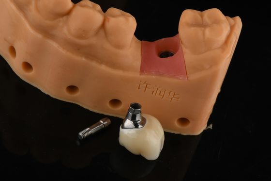 Präzisionszylindrische Silber-Einzelzahnersatz-Implantate Zahnrestaurierung